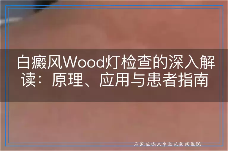 白癜风Wood灯检查的深入解读：原理、应用与患者指南