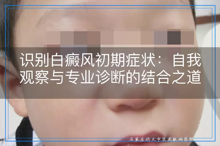 识别白癜风初期症状：自我观察与专业诊断的结合之道