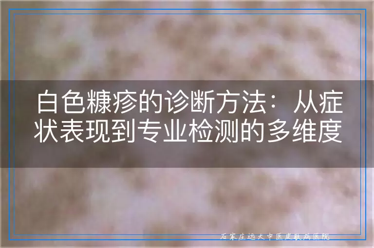 白色糠疹的诊断方法：从症状表现到专业检测的多维度考量