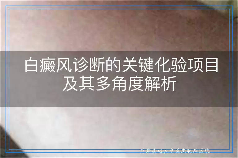 白癜风诊断的关键化验项目及其多角度解析