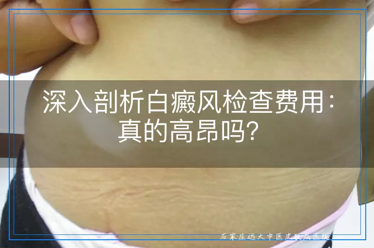 深入剖析白癜风检查费用：真的高昂吗？