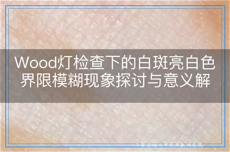 Wood灯检查下的白斑亮白色界限模糊现象探讨与意义解读