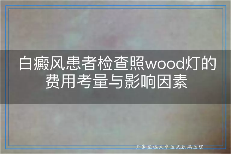 白癜风患者检查照wood灯的费用考量与影响因素