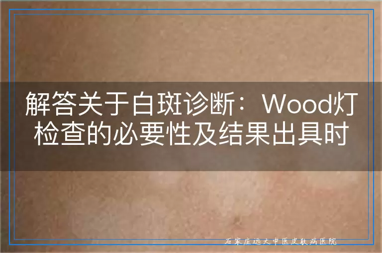 解答关于白斑诊断：Wood灯检查的必要性及结果出具时间详解