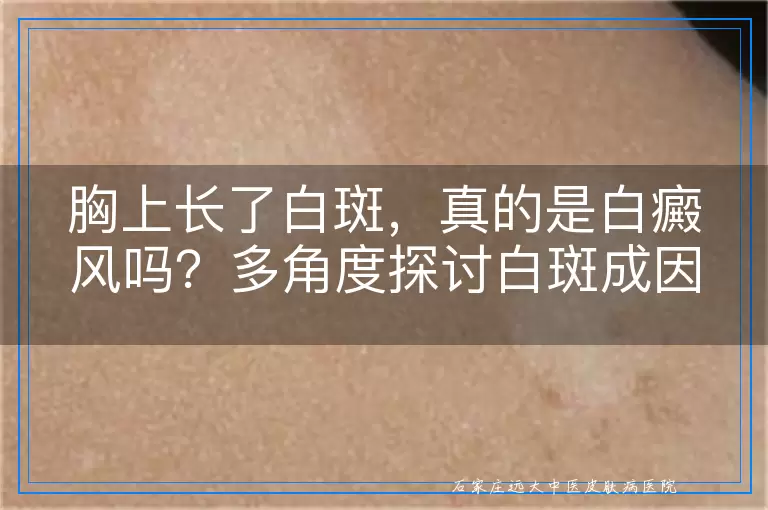胸上长了白斑，真的是白癜风吗？多角度探讨白斑成因