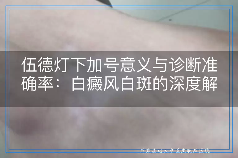 伍德灯下加号意义与诊断准确率：白癜风白斑的深度解读