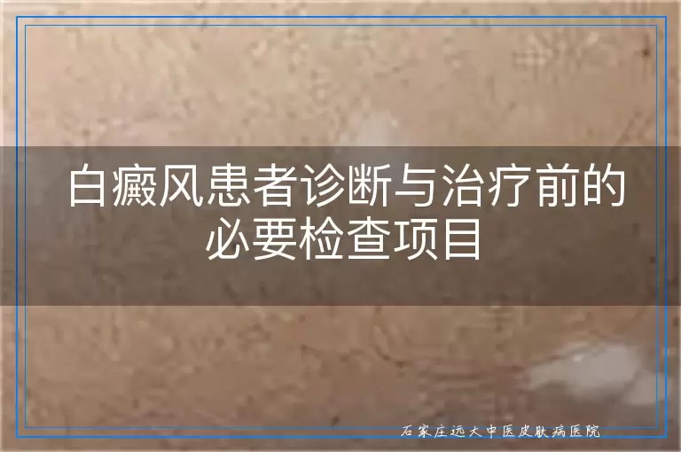 白癜风患者诊断与治疗前的必要检查项目