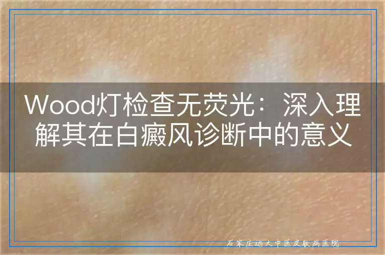Wood灯检查无荧光：深入理解其在白癜风诊断中的意义与局限
