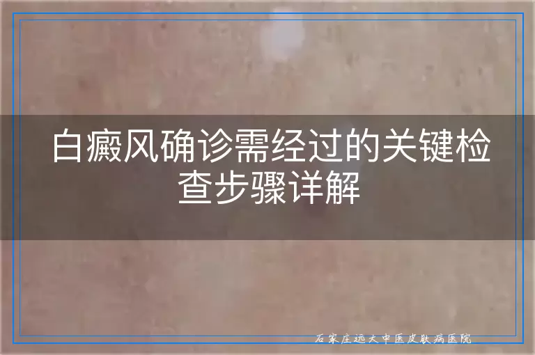 白癜风确诊需经过的关键检查步骤详解
