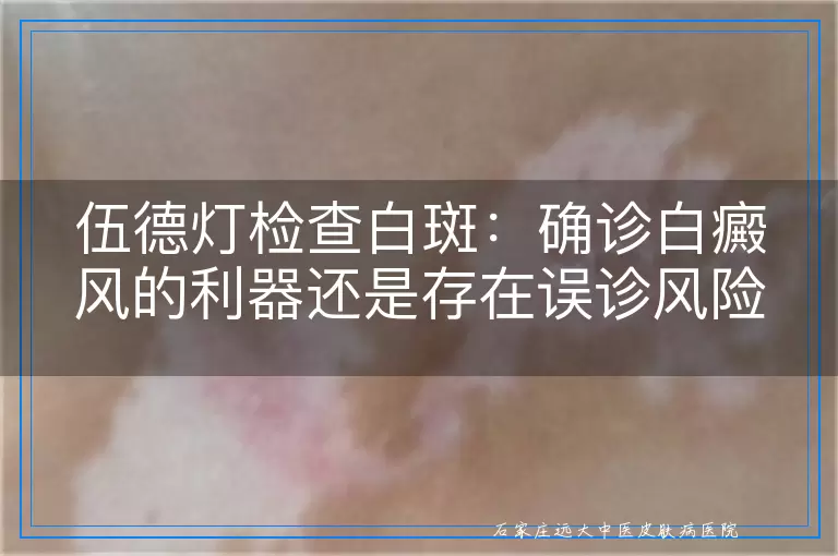 伍德灯检查白斑：确诊白癜风的利器还是存在误诊风险的工具？