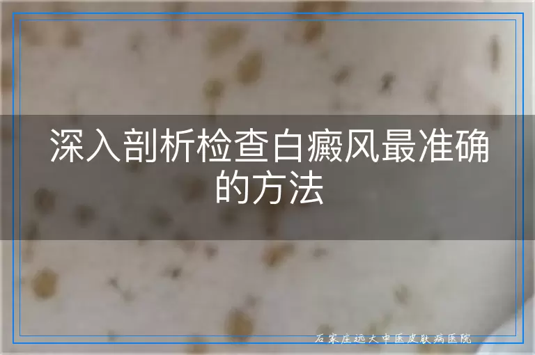 深入剖析检查白癜风最准确的方法