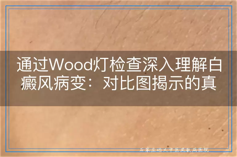 通过Wood灯检查深入理解白癜风病变：对比图揭示的真相