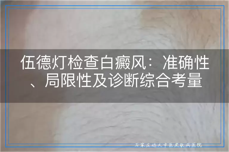 伍德灯检查白癜风：准确性、局限性及诊断综合考量