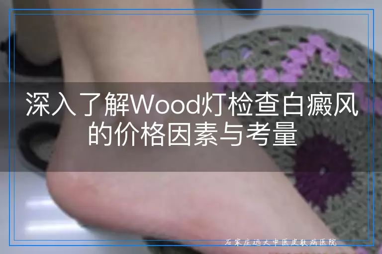 深入了解Wood灯检查白癜风的价格因素与考量