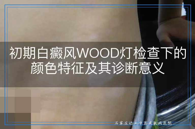 初期白癜风WOOD灯检查下的颜色特征及其诊断意义
