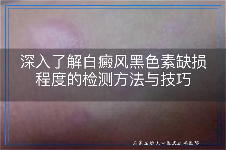深入了解白癜风黑色素缺损程度的检测方法与技巧