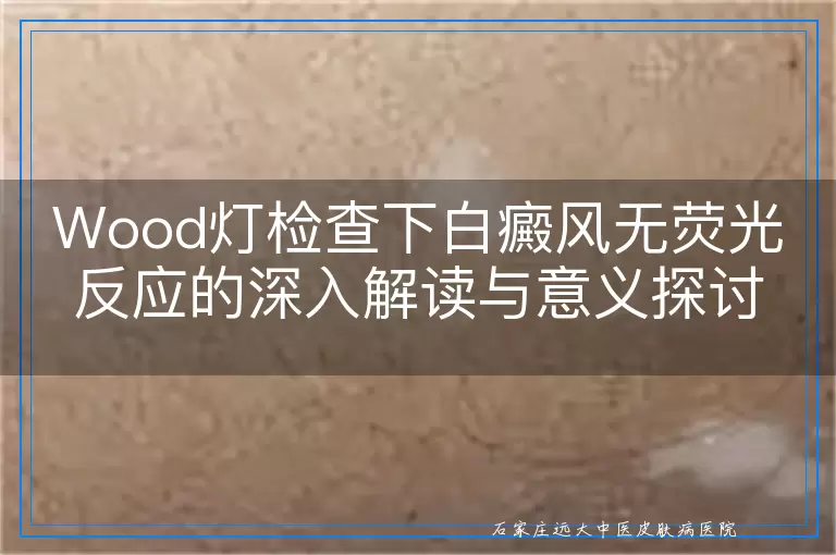 Wood灯检查下白癜风无荧光反应的深入解读与意义探讨