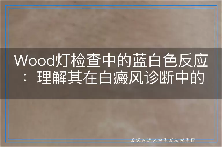 Wood灯检查中的蓝白色反应：理解其在白癜风诊断中的独特价值