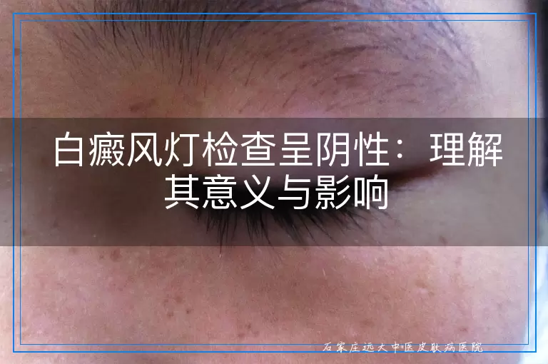 白癜风灯检查呈阴性：理解其意义与影响