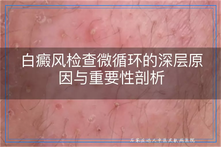 白癜风检查微循环的深层原因与重要性剖析