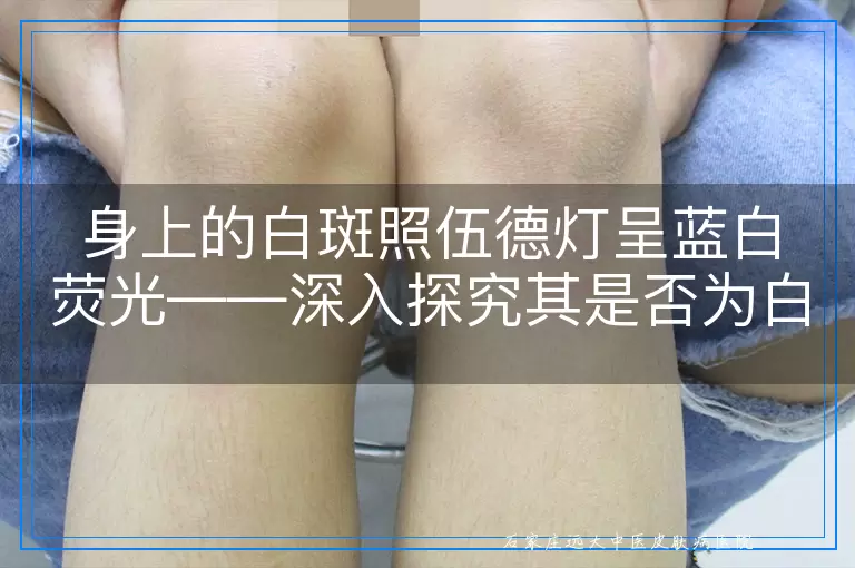 身上的白斑照伍德灯呈蓝白荧光——深入探究其是否为白癜风的标志