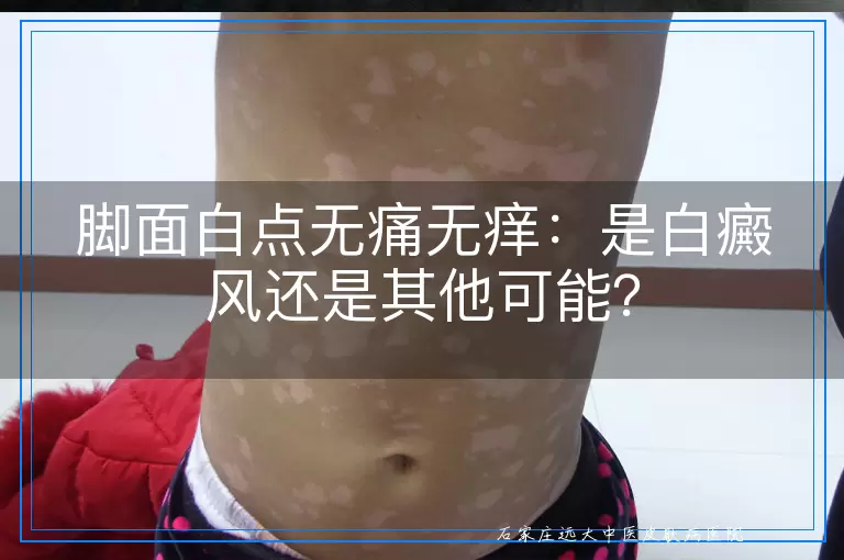 脚面白点无痛无痒：是白癜风还是其他可能？