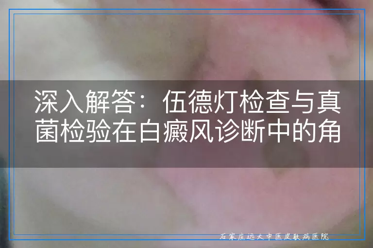 深入解答：伍德灯检查与真菌检验在白癜风诊断中的角色与局限性