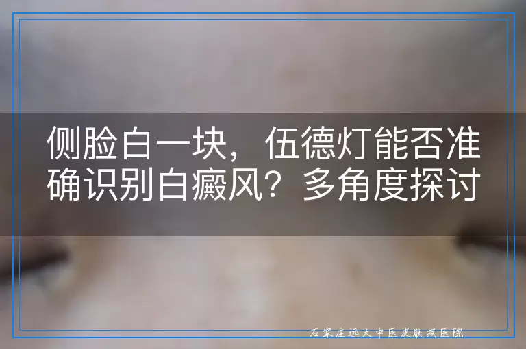 侧脸白一块，伍德灯能否准确识别白癜风？多角度探讨其诊断价值