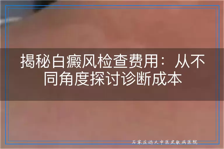 揭秘白癜风检查费用：从不同角度探讨诊断成本