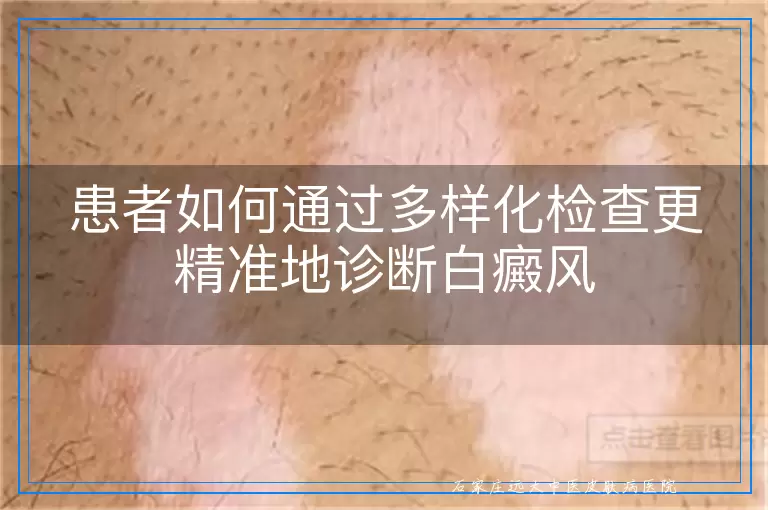 患者如何通过多样化检查更精准地诊断白癜风