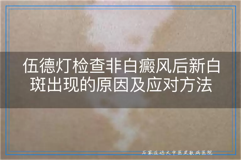 伍德灯检查非白癜风后新白斑出现的原因及应对方法