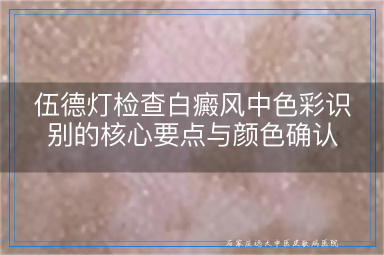 伍德灯检查白癜风中色彩识别的核心要点与颜色确认