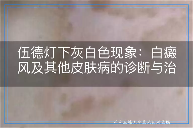 伍德灯下灰白色现象：白癜风及其他皮肤病的诊断与治疗指南