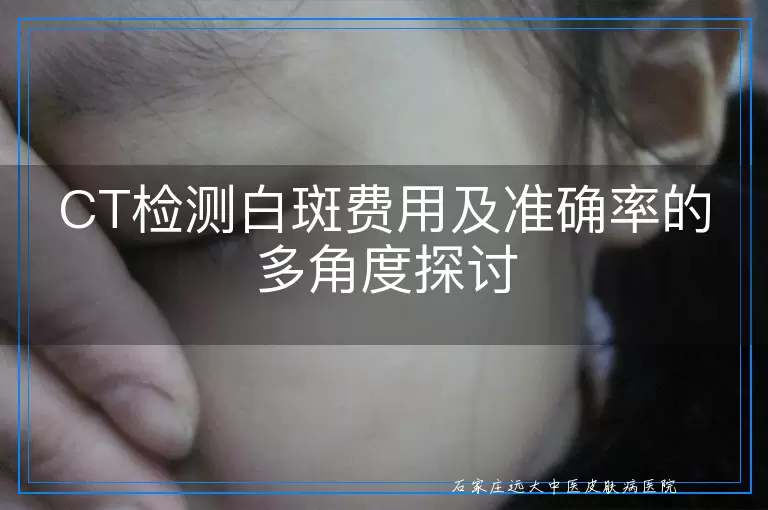 CT检测白斑费用及准确率的多角度探讨