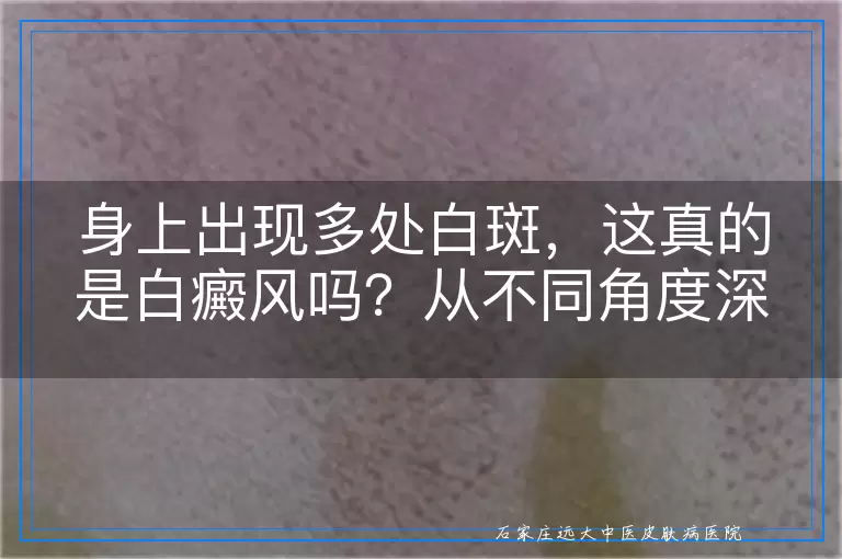 身上出现多处白斑，这真的是白癜风吗？从不同角度深入解读