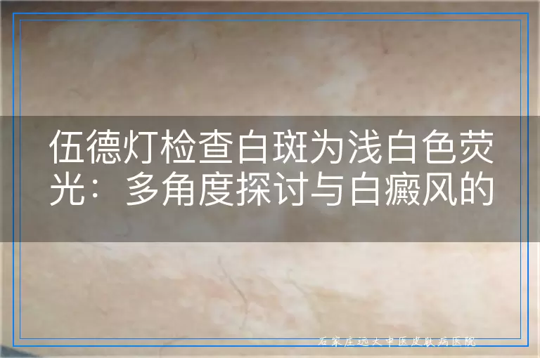 伍德灯检查白斑为浅白色荧光：多角度探讨与白癜风的关系