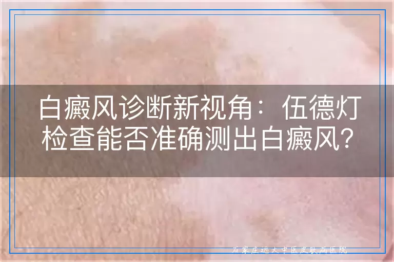 白癜风诊断新视角：伍德灯检查能否准确测出白癜风？