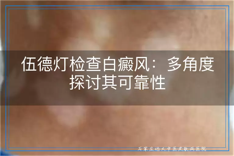 伍德灯检查白癜风：多角度探讨其可靠性