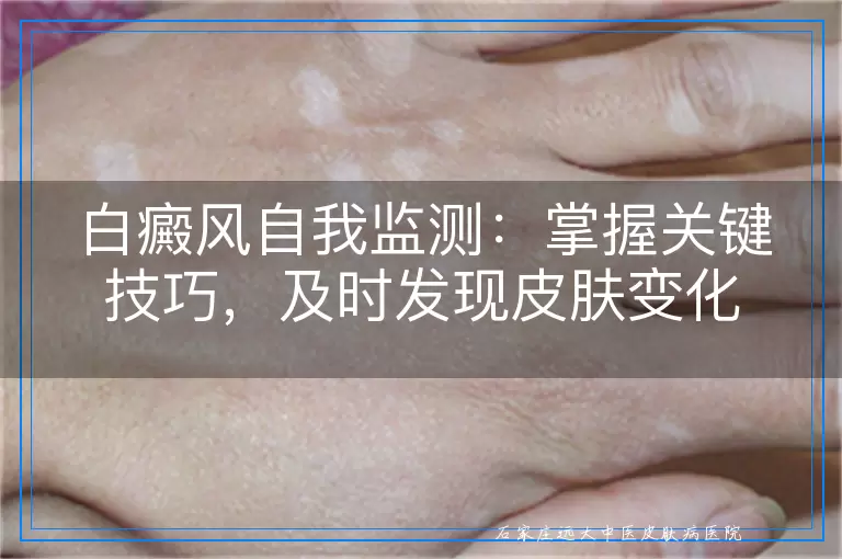 白癜风自我监测：掌握关键技巧，及时发现皮肤变化