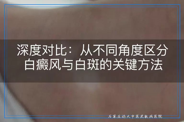 深度对比：从不同角度区分白癜风与白斑的关键方法