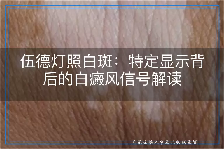伍德灯照白斑：特定显示背后的白癜风信号解读