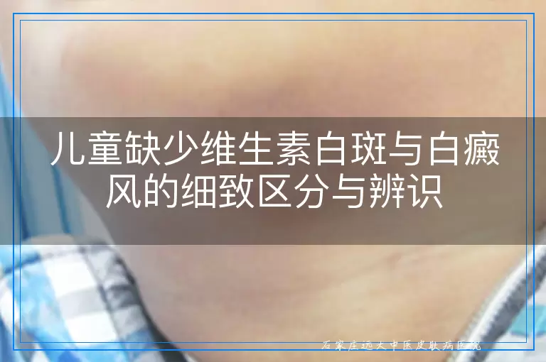儿童缺少维生素白斑与白癜风的细致区分与辨识
