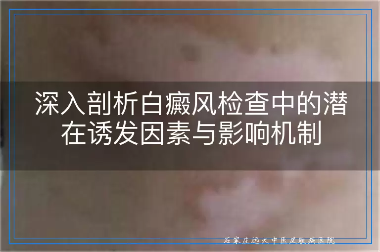 深入剖析白癜风检查中的潜在诱发因素与影响机制