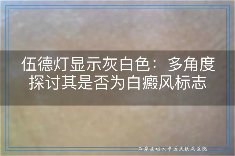 伍德灯显示灰白色：多角度探讨其是否为白癜风标志