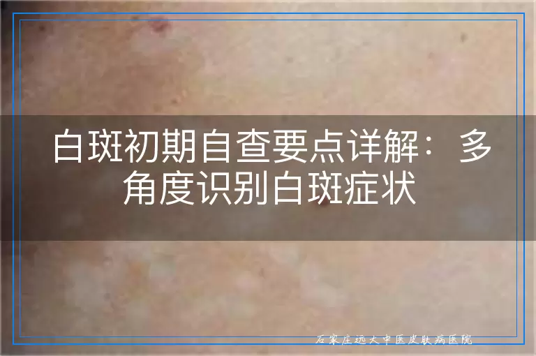 白斑初期自查要点详解：多角度识别白斑症状