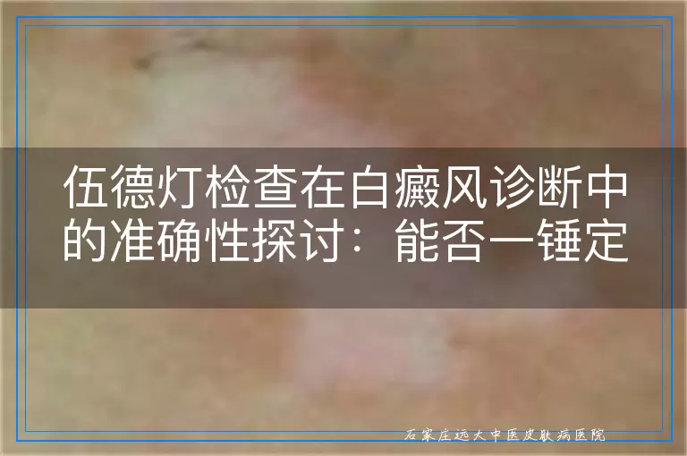 伍德灯检查在白癜风诊断中的准确性探讨：能否一锤定音？