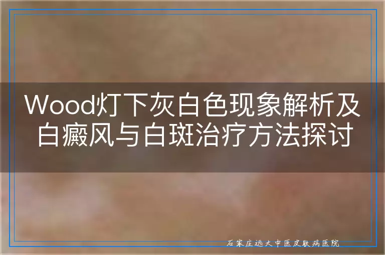 Wood灯下灰白色现象解析及白癜风与白斑治疗方法探讨
