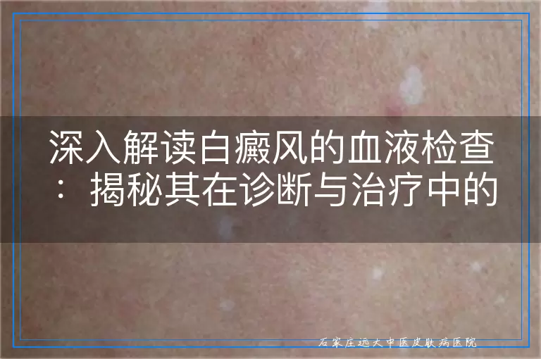 深入解读白癜风的血液检查：揭秘其在诊断与治疗中的作用