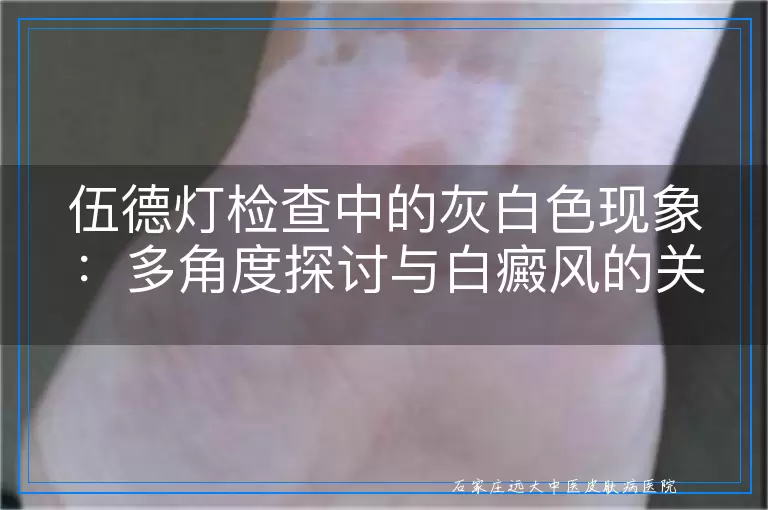 伍德灯检查中的灰白色现象：多角度探讨与白癜风的关系