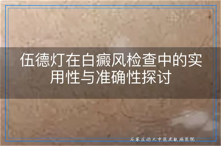 伍德灯在白癜风检查中的实用性与准确性探讨